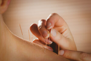 Dry Needling Treatment