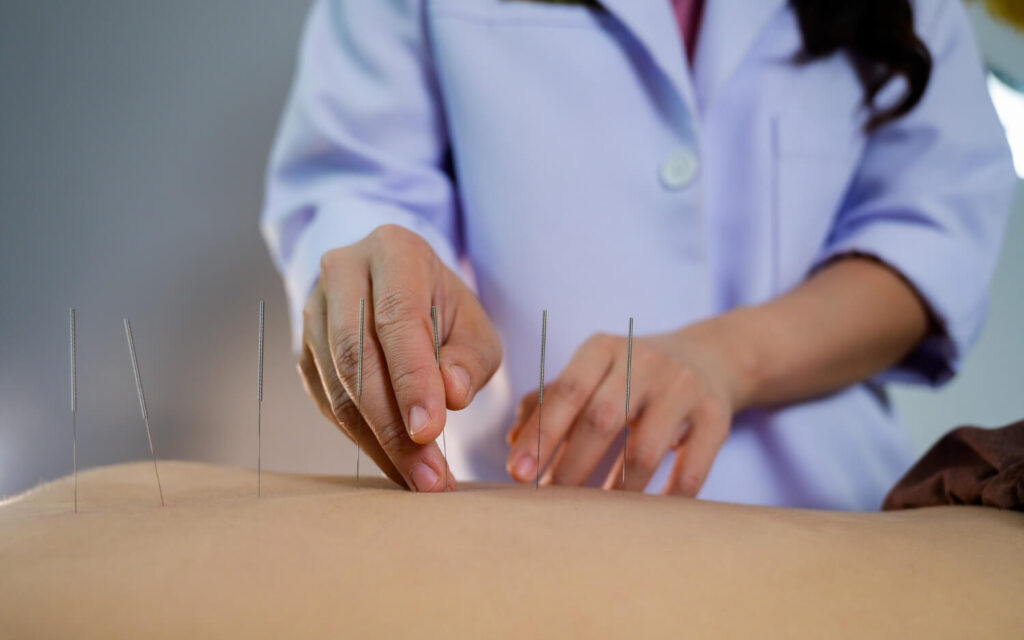 Dry Needling for Hamstring Muscles Trigger Points -